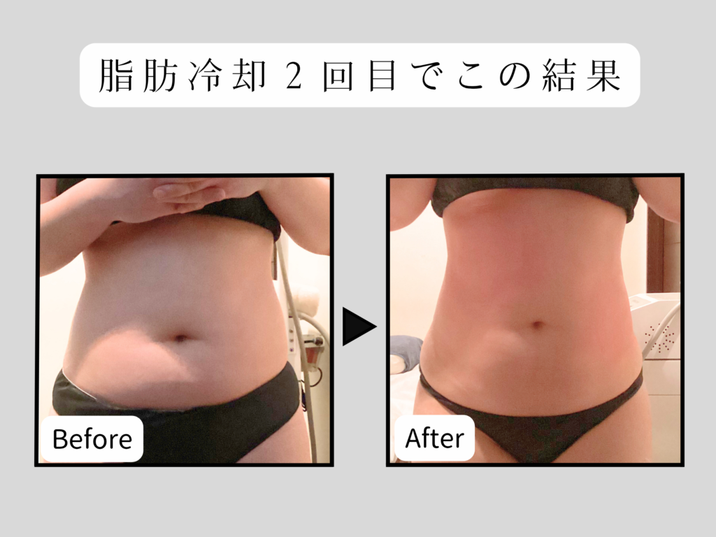 豊田市のエステサロンKroneの脂肪冷却のビフォーアフター