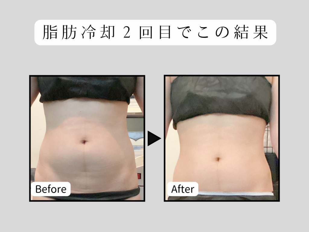 豊田市のエステサロンKroneの脂肪冷却のビフォーアフター