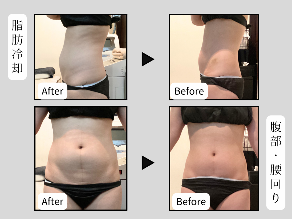 脂肪冷却ビフォーアフター