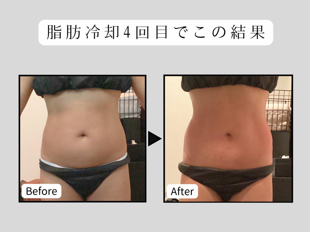 ビフォーアフター脂肪冷却